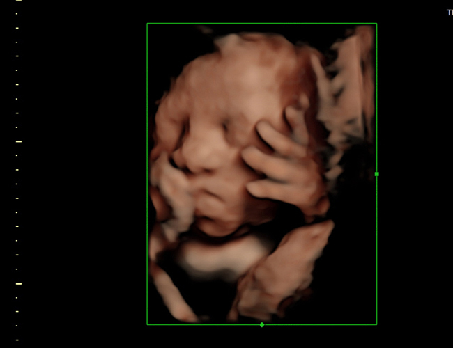 3D ultrasound image at 29 weeks